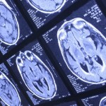 Examine Brain Niemann Pick Disease