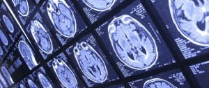 Examine Brain Niemann Pick Disease